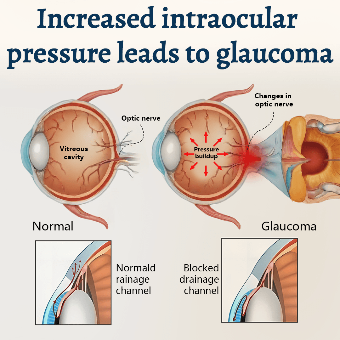 Glaucoma and eye pressure education