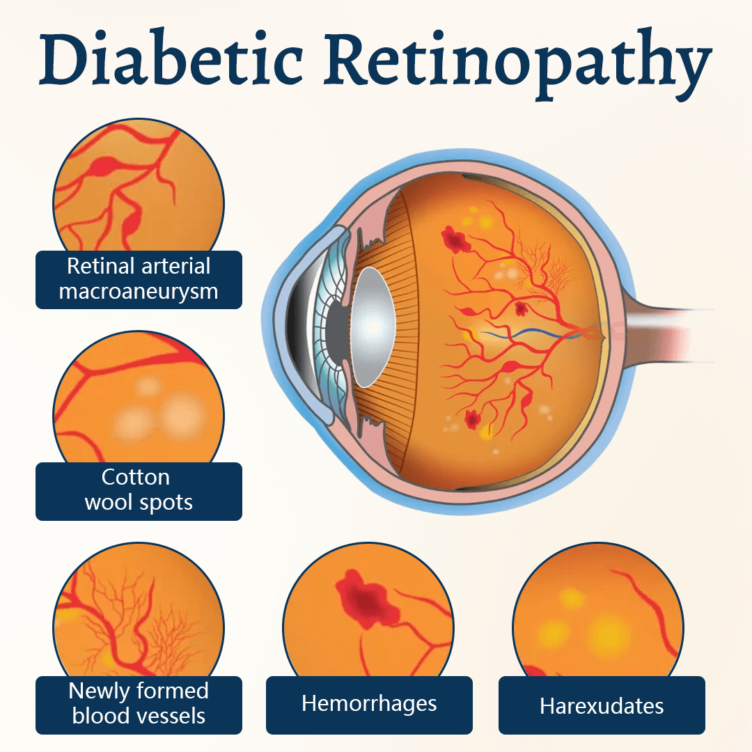 Diabetic retinopathy educational diagram
