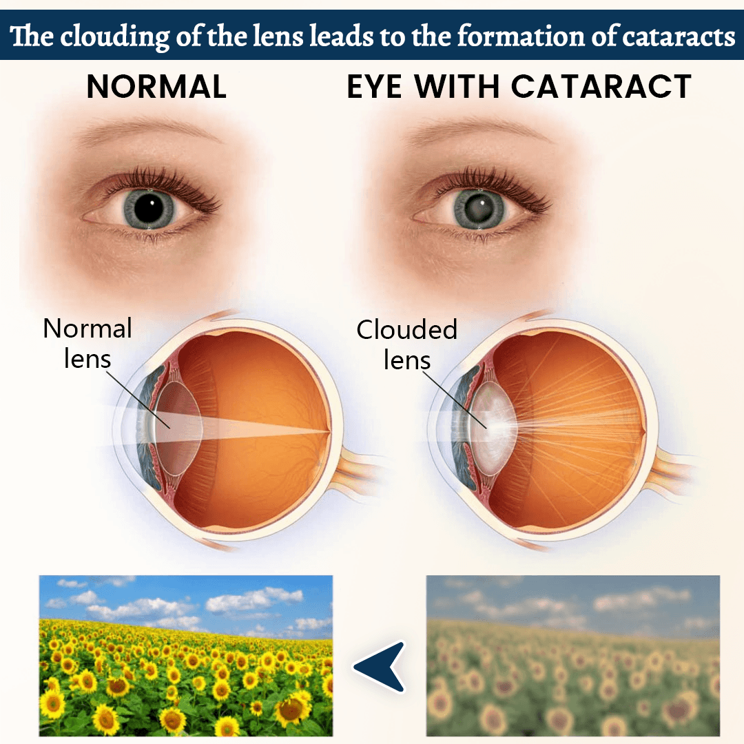 Cataract education and clouded lens comparison